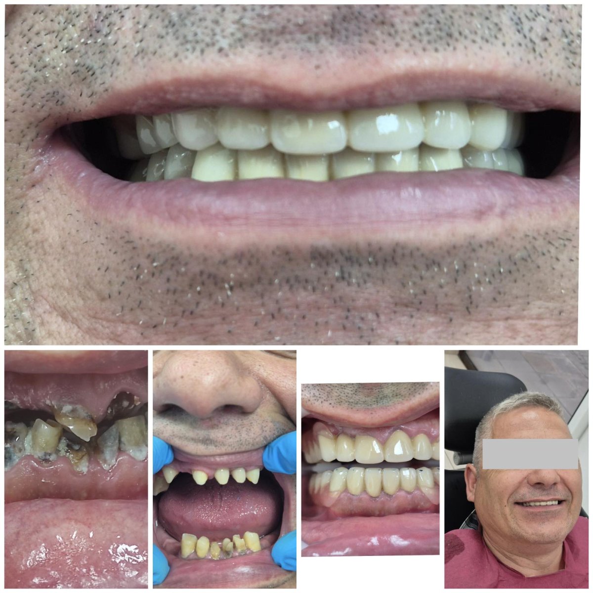 Resultados antes y después de coronas dentales en AllDental: sonrisa restaurada