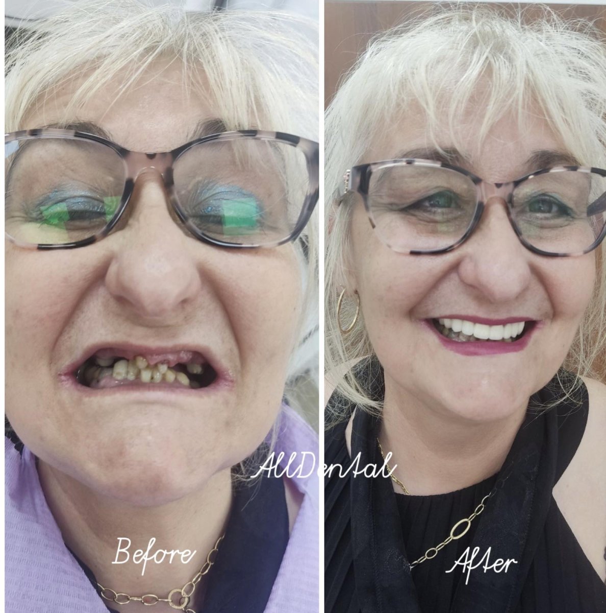 Antes y después de la colocación de coronas dentales en AllDental: resultados de sonrisa