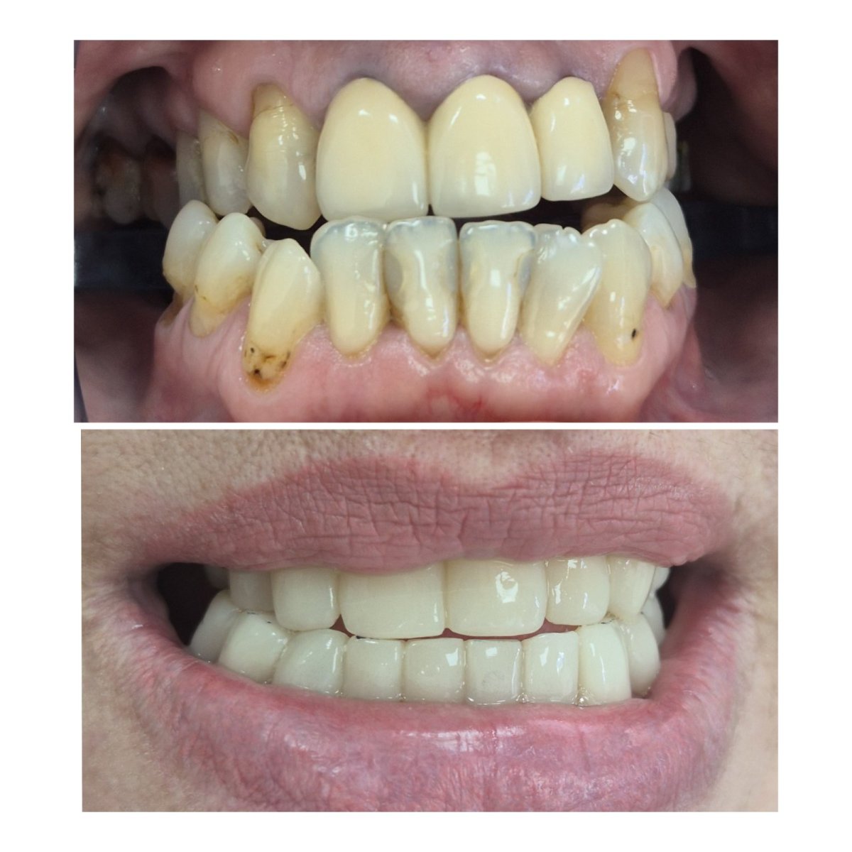 Antes y después de coronas dentales en AllDental: sonrisa mejorada y dientes más blancos