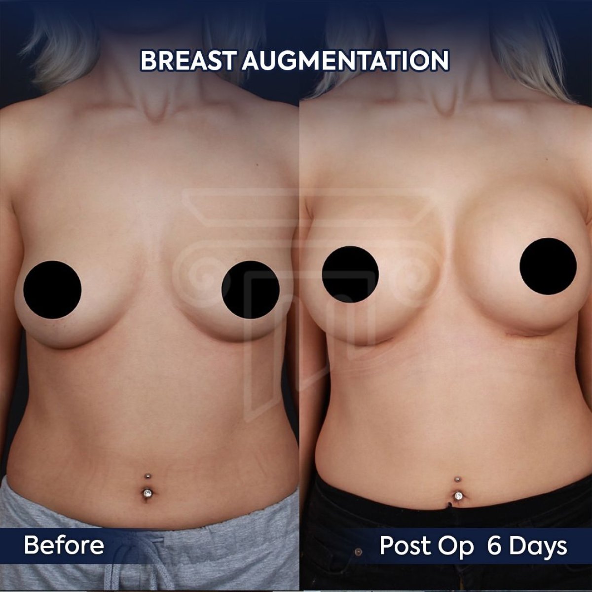 Resultados antes y después de aumento de senos en Dr. Safa Manav Clinic, 6 días postoperatorio