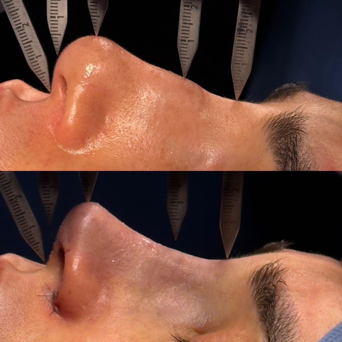 Before and after ultrasonic rhinoplasty result at Dr. Fabiano Arruda – plastic surgery (Goiânia)