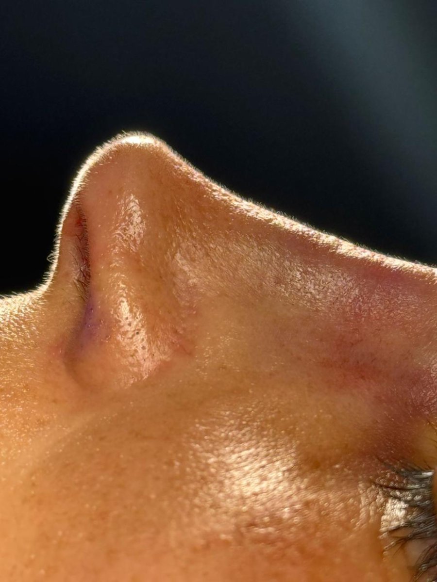 Ultrasonic rhinoplasty result at Dr. Fabiano Arruda – plastic surgery (Goiânia), refined nose shape
