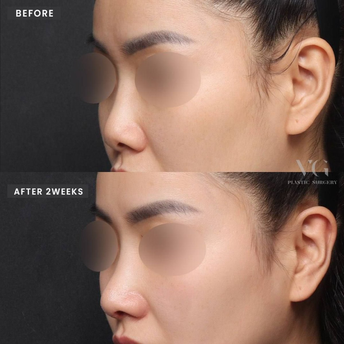نتائج قبل وبعد عملية تجميل الأنف التصحيحية في VG Plastic Surgery، تحسين شكل الأنف