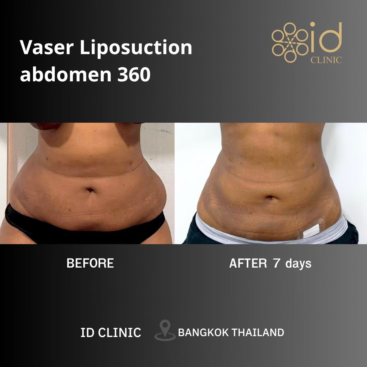 نتائج قبل وبعد شفط الدهون فايزر للبطن 360 في ID Clinic Bangkok، خصر أنحف