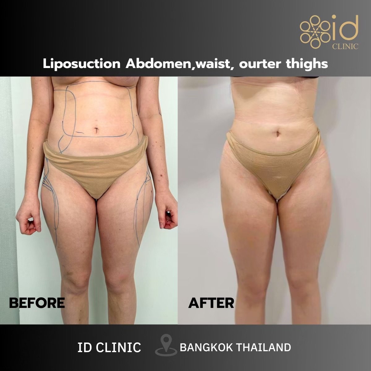 نتائج شفط الدهون فايزر للبطن والخصر والفخذين قبل وبعد في ID Clinic Bangkok