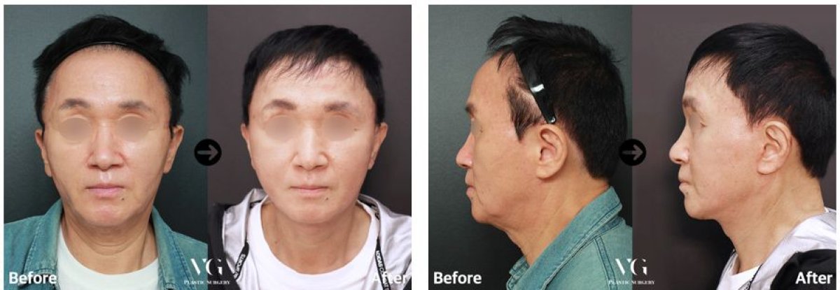 Resultados antes y después de deep plane facelift en VG Plastic Surgery, rejuvenecimiento facial