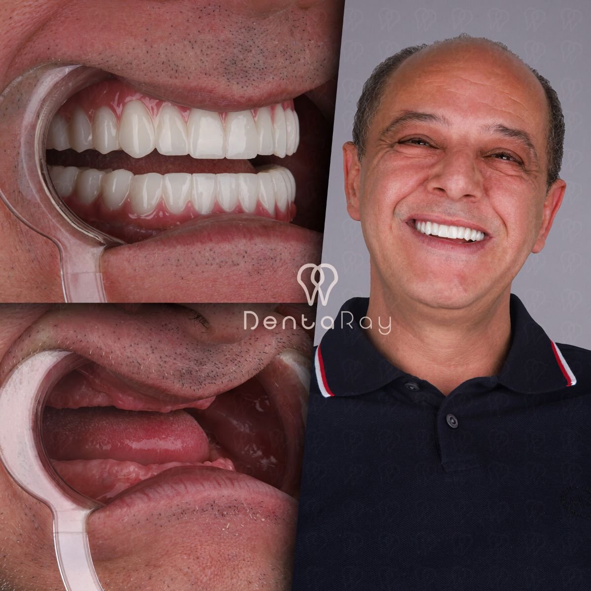 Результат до и после имплантации All-on-6 в клинике Dentaray, полное восстановление улыбки