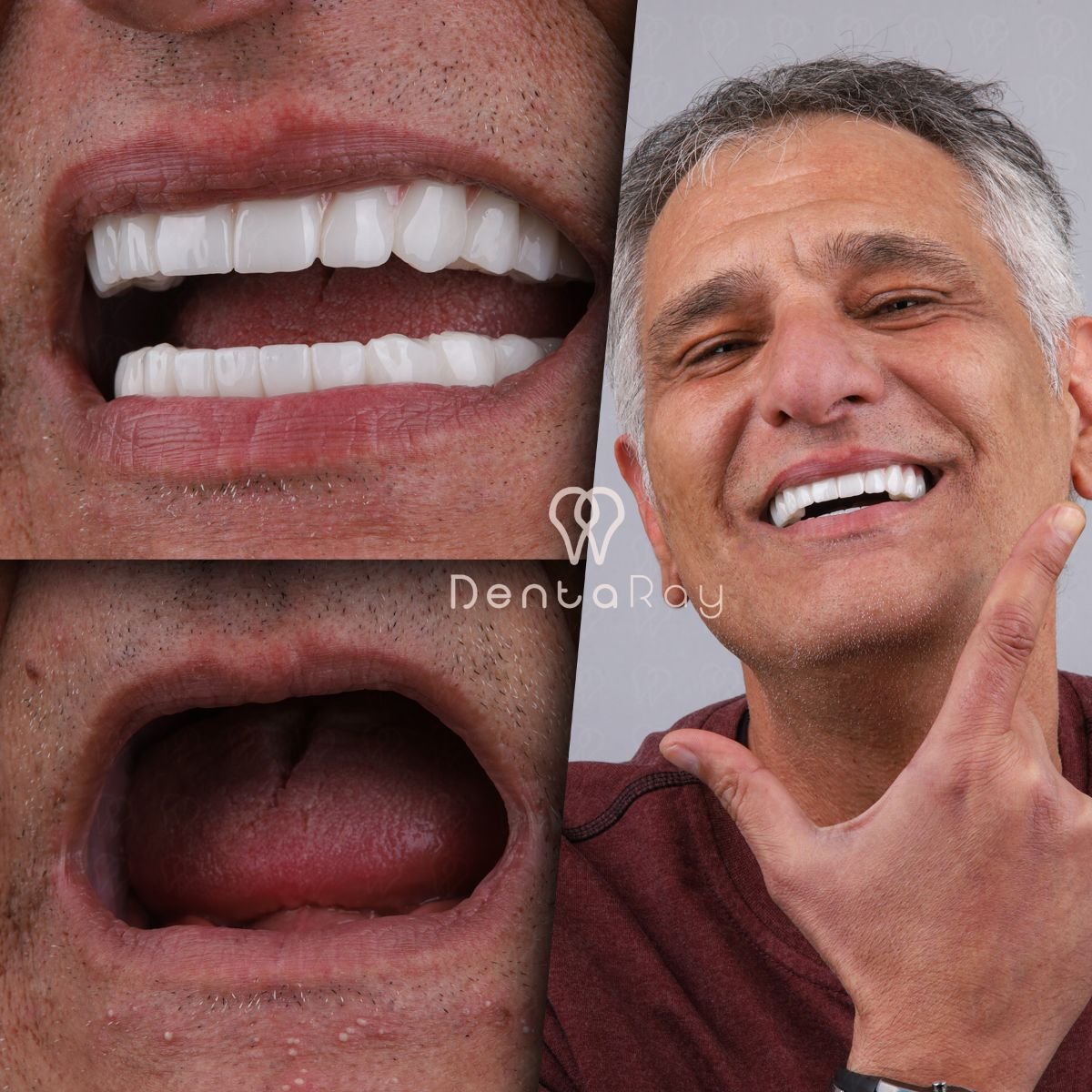نتائج قبل وبعد زراعة الأسنان All-on-6 في عيادة Dentaray، استعادة الابتسامة
