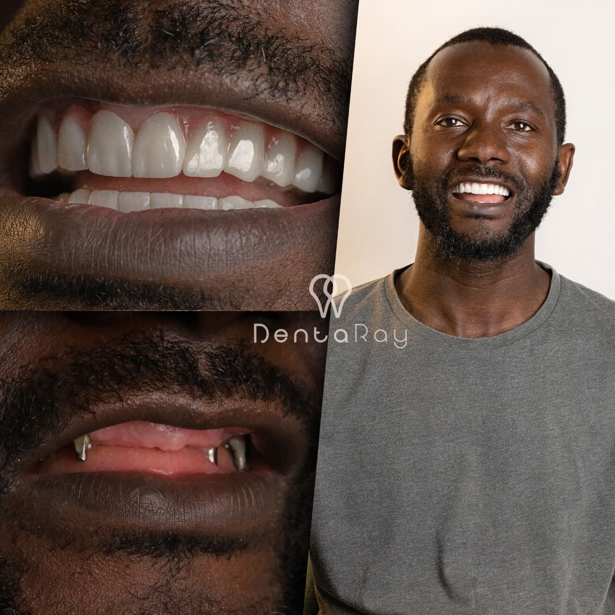 نتيجة قبل وبعد زراعة الأسنان All-on-6 في عيادة Dentaray، ابتسامة مستعادة