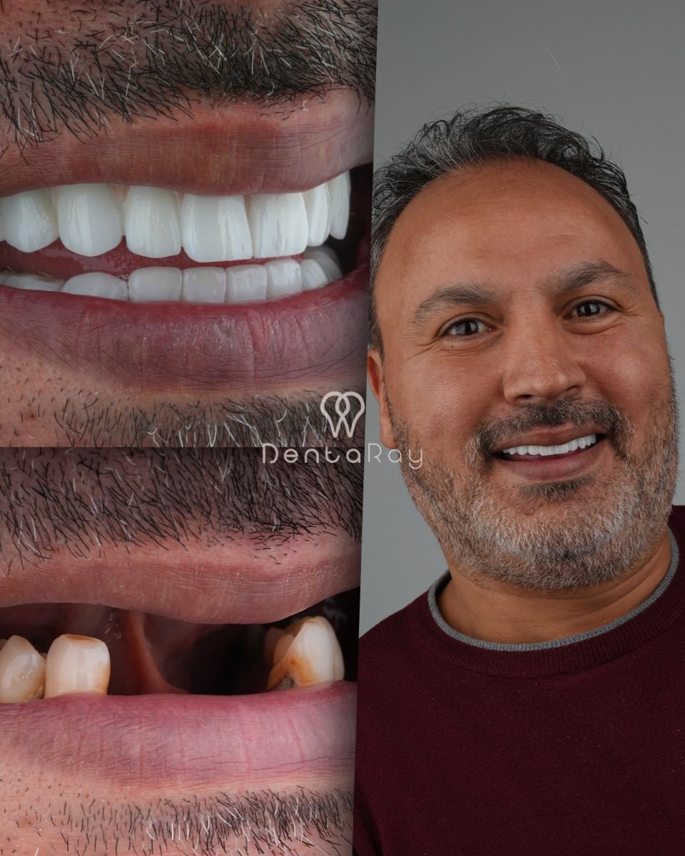 نتائج قبل وبعد زراعة الأسنان All-on-6 في عيادة Dentaray، ابتسامة مستعادة