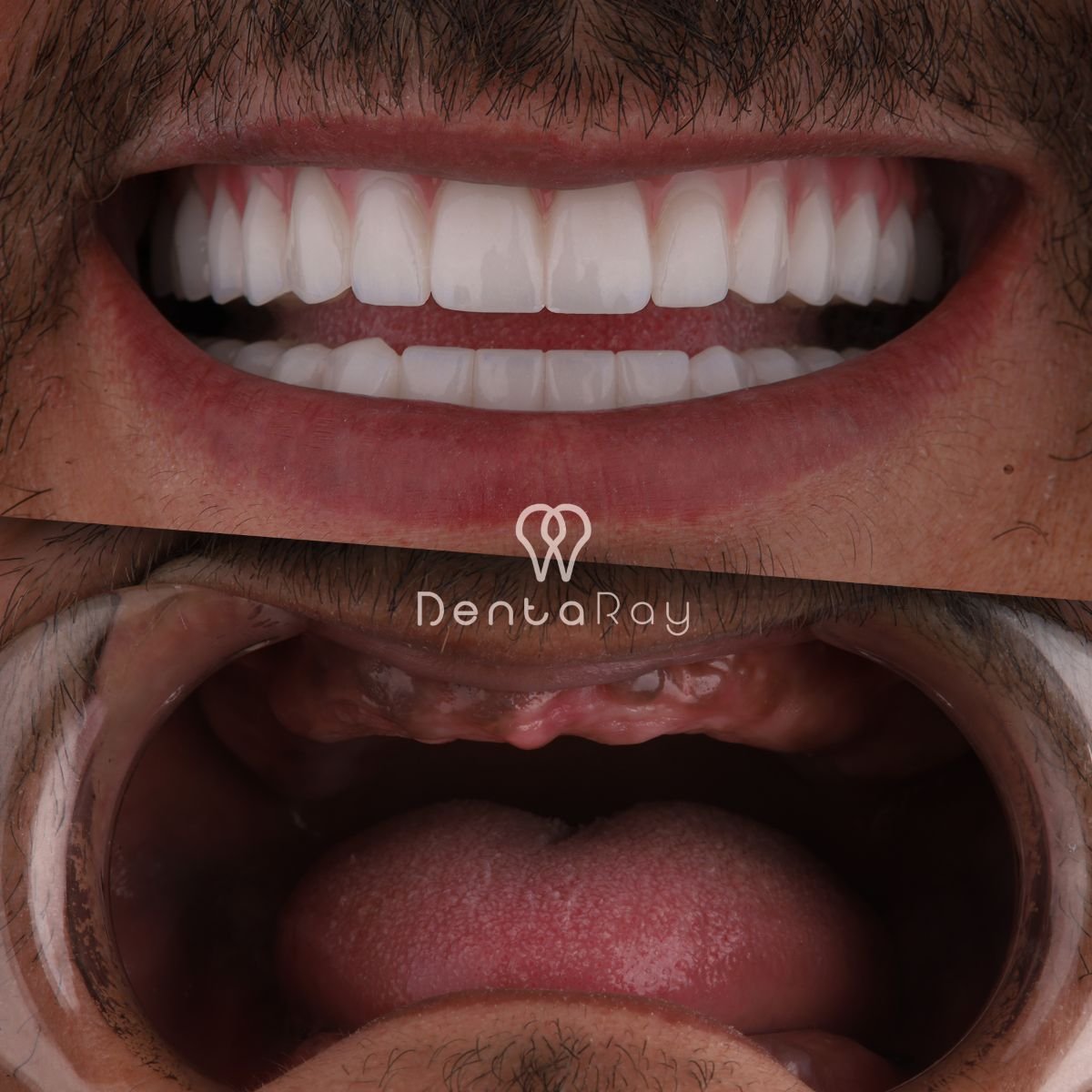 Resultados de implantes dentales All-on-6 antes y después en Dentaray Clinic, sonrisa completa