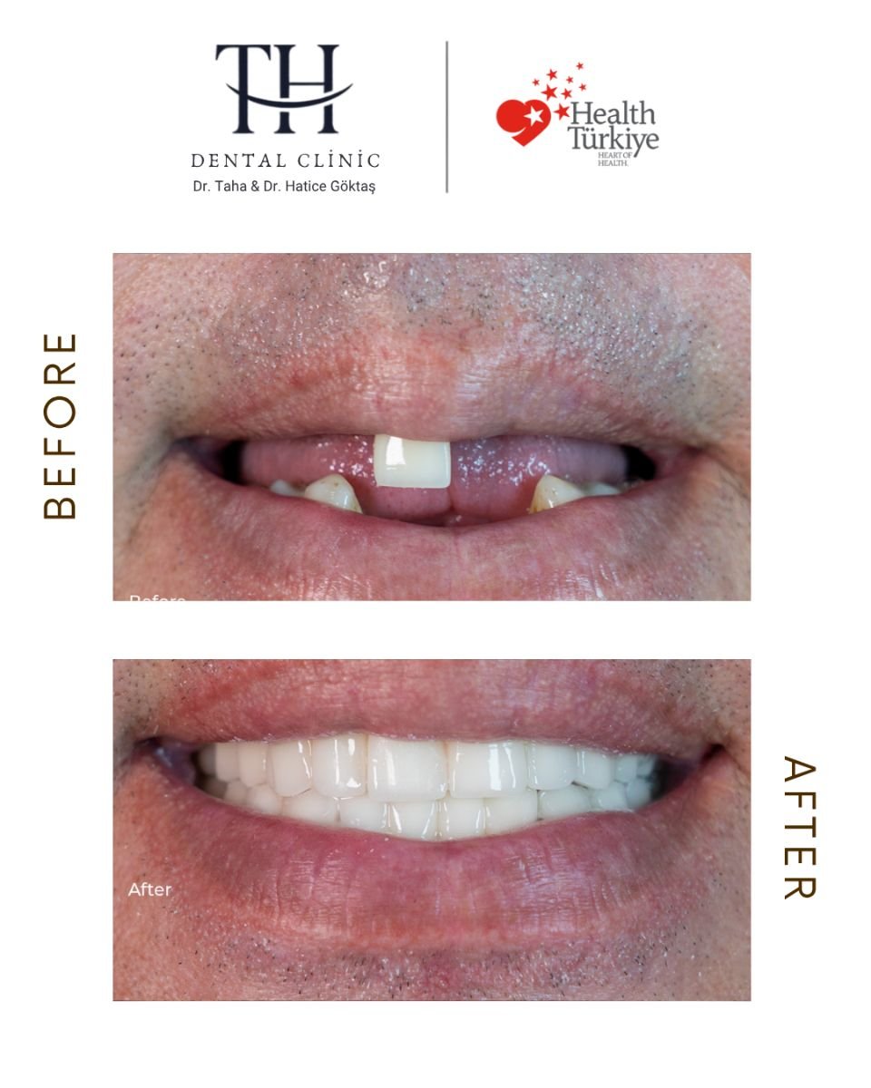 Resultados antes y después de implantes dentales All-on-6 en TH Dental Clinic, sonrisa restaurada