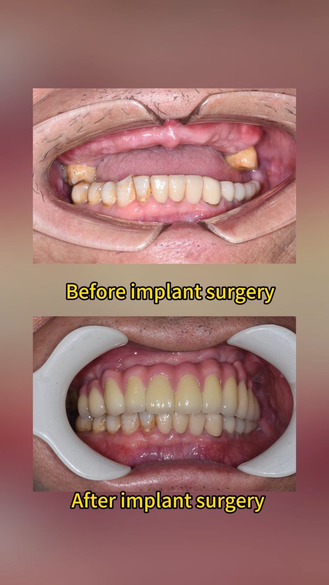 Before and after dental implant results at Qinghua Sunshine Dentistry, improved smile restoration