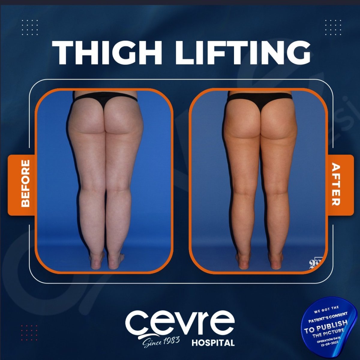 Resultados antes y después de lifting de muslos en Adem and Havva Medical Center, mejor contorno