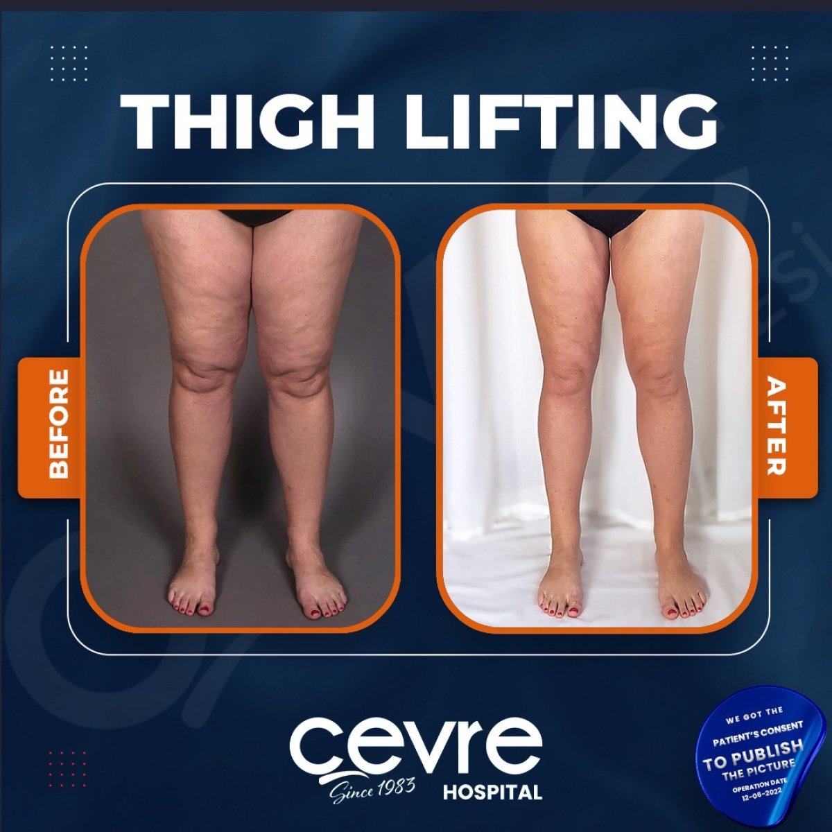 Resultados antes y después de lifting de muslos en Adem and Havva Medical Center, mejor contorno