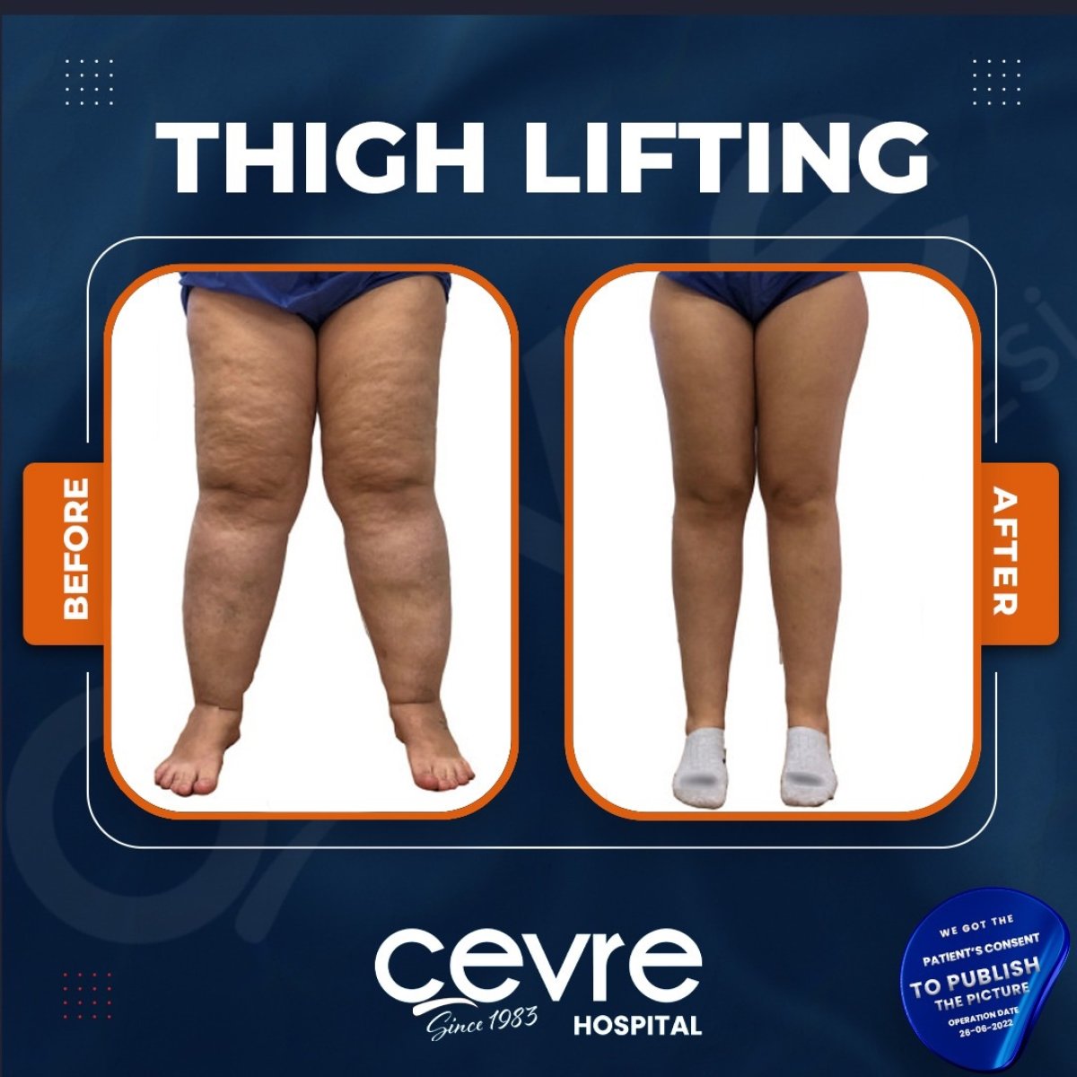 Resultados de lifting de muslos antes y después en Adem and Havva Medical Center, mejor contorno