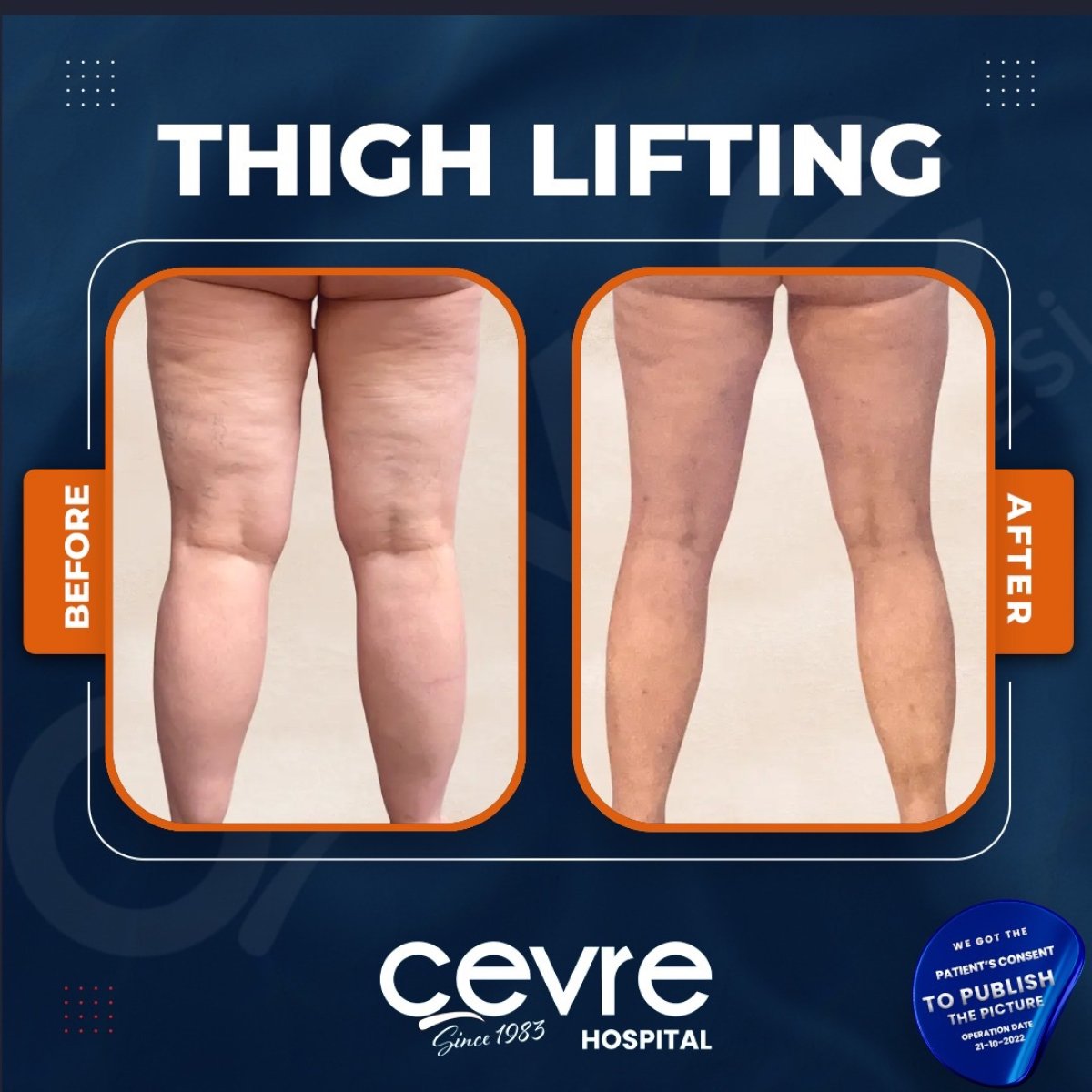 Résultats avant/après lifting des cuisses à Adem and Havva Medical Center, contour amélioré