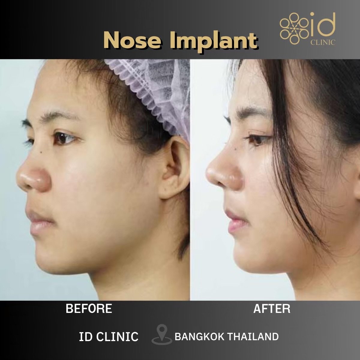 Результати до і після імплантації носа в ID Clinic Bangkok, покращений профіль носа