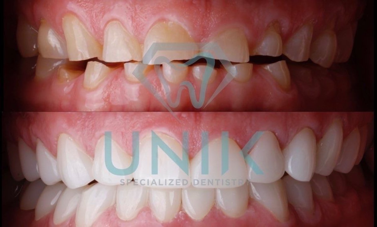 before and after photo