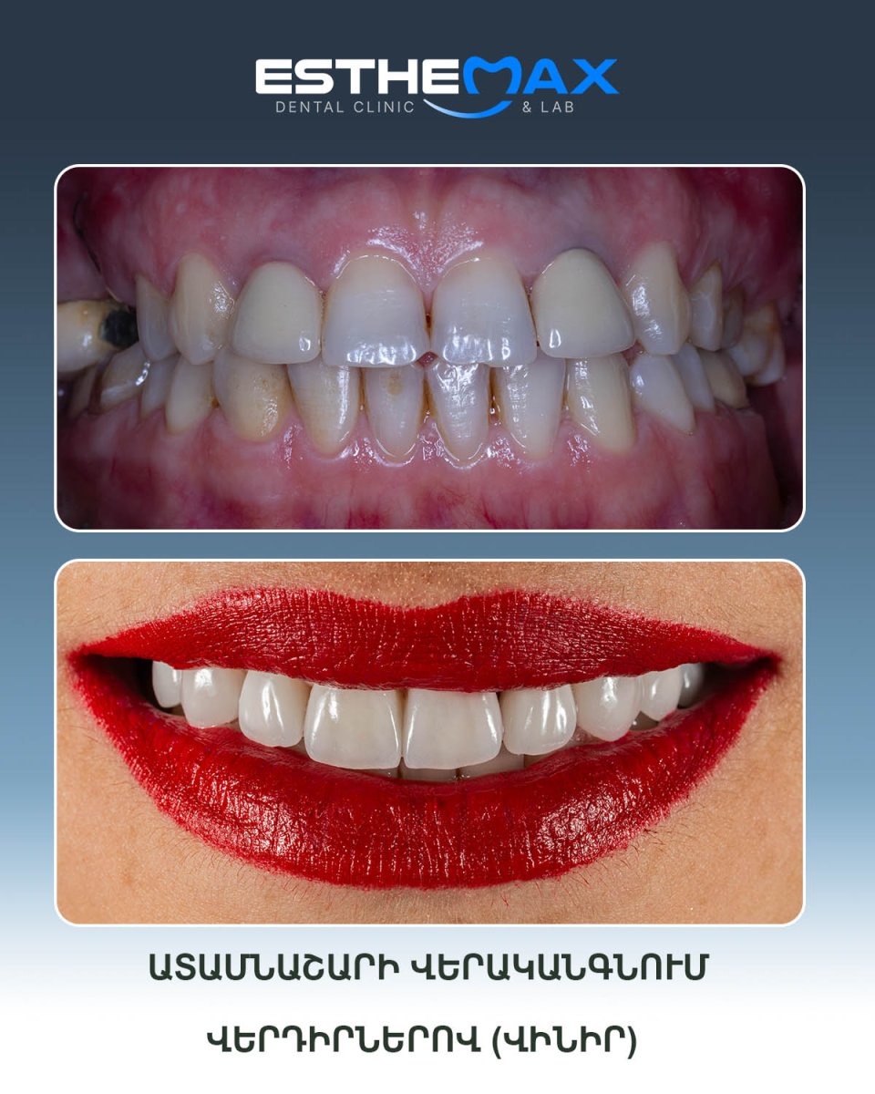 نتيجة قبل وبعد عدسات الأسنان في عيادة Esthemax – تحول الابتسامة