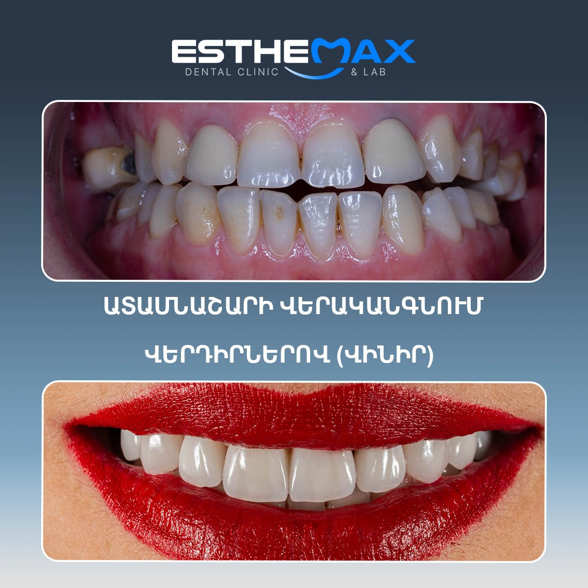 نتيجة الفينير قبل وبعد في عيادة Esthemax – تحول الابتسامة