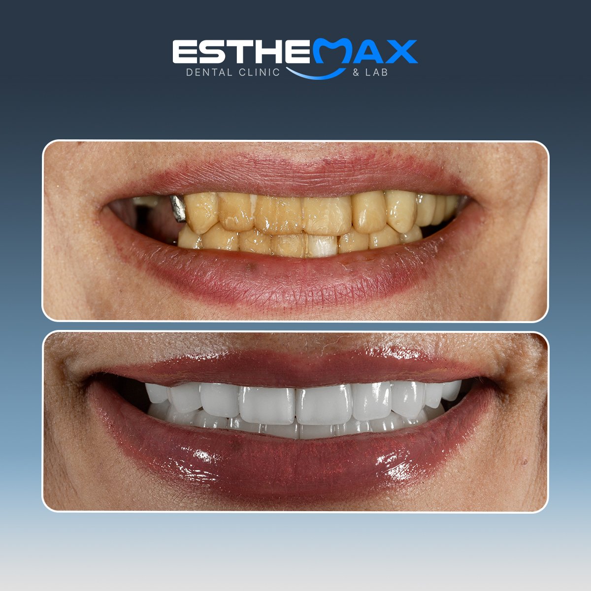 نتائج زراعة الأسنان قبل وبعد في عيادة Esthemax – ابتسامة بيضاء مستعادة