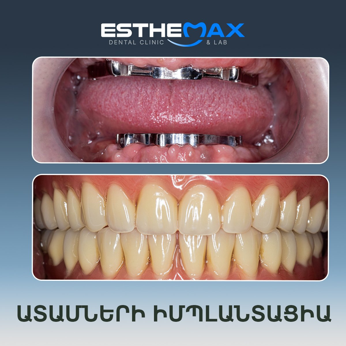 نتائج زراعة الأسنان قبل وبعد في عيادة Esthemax – استعادة الابتسامة الكاملة