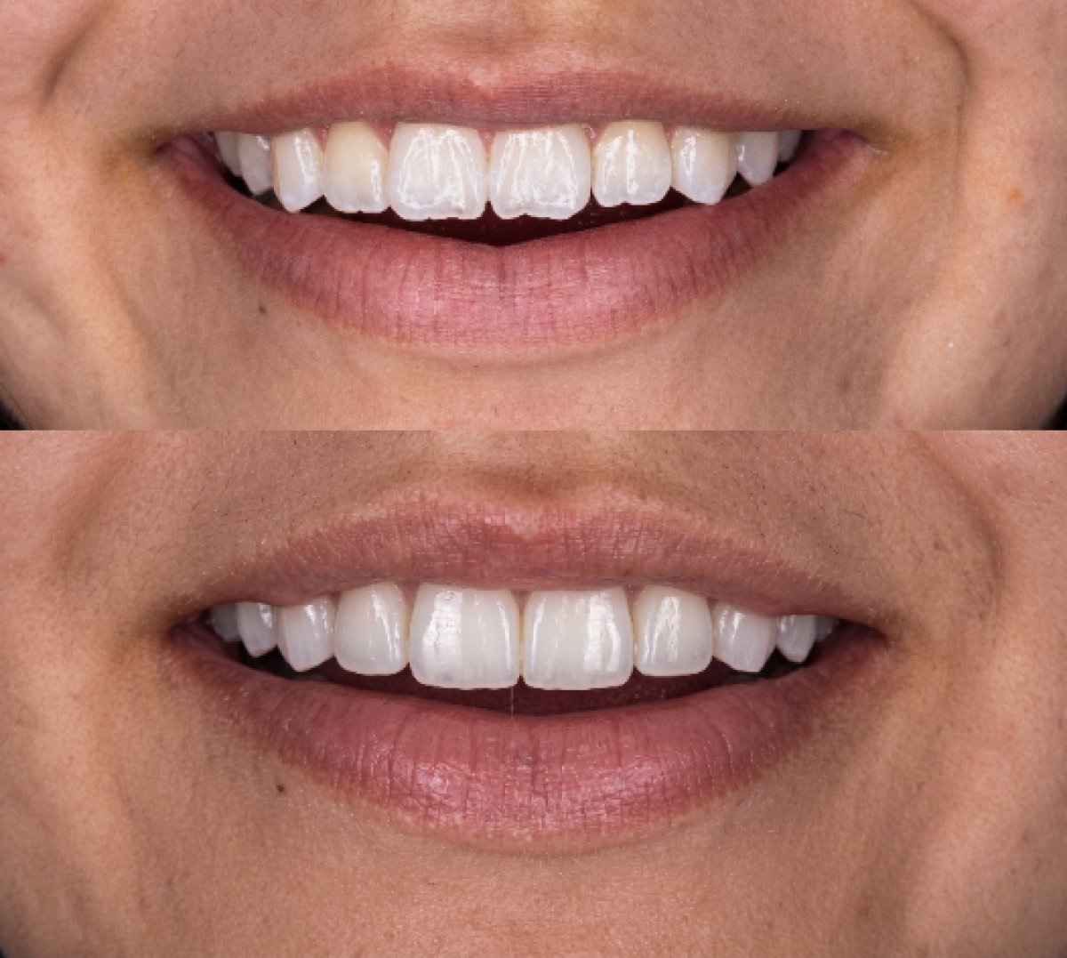 Resultados de antes y después de smile makeover en Dental Bliss: mejor alineación y color dental