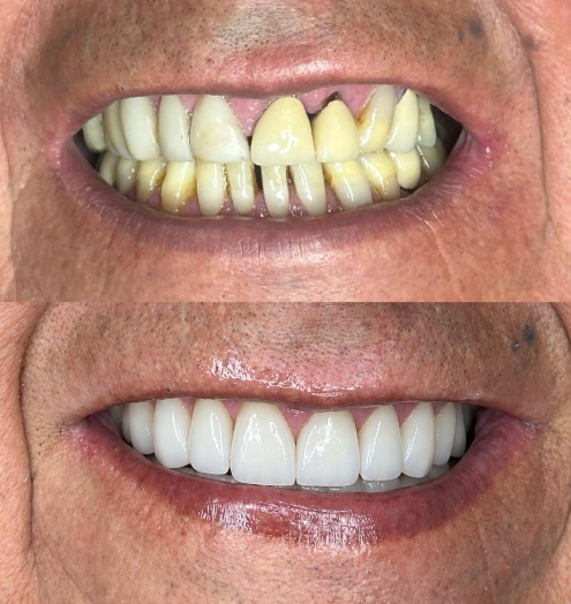 Antes y después de smile makeover en Dental Bliss: carillas dentales para dientes blancos y parejos