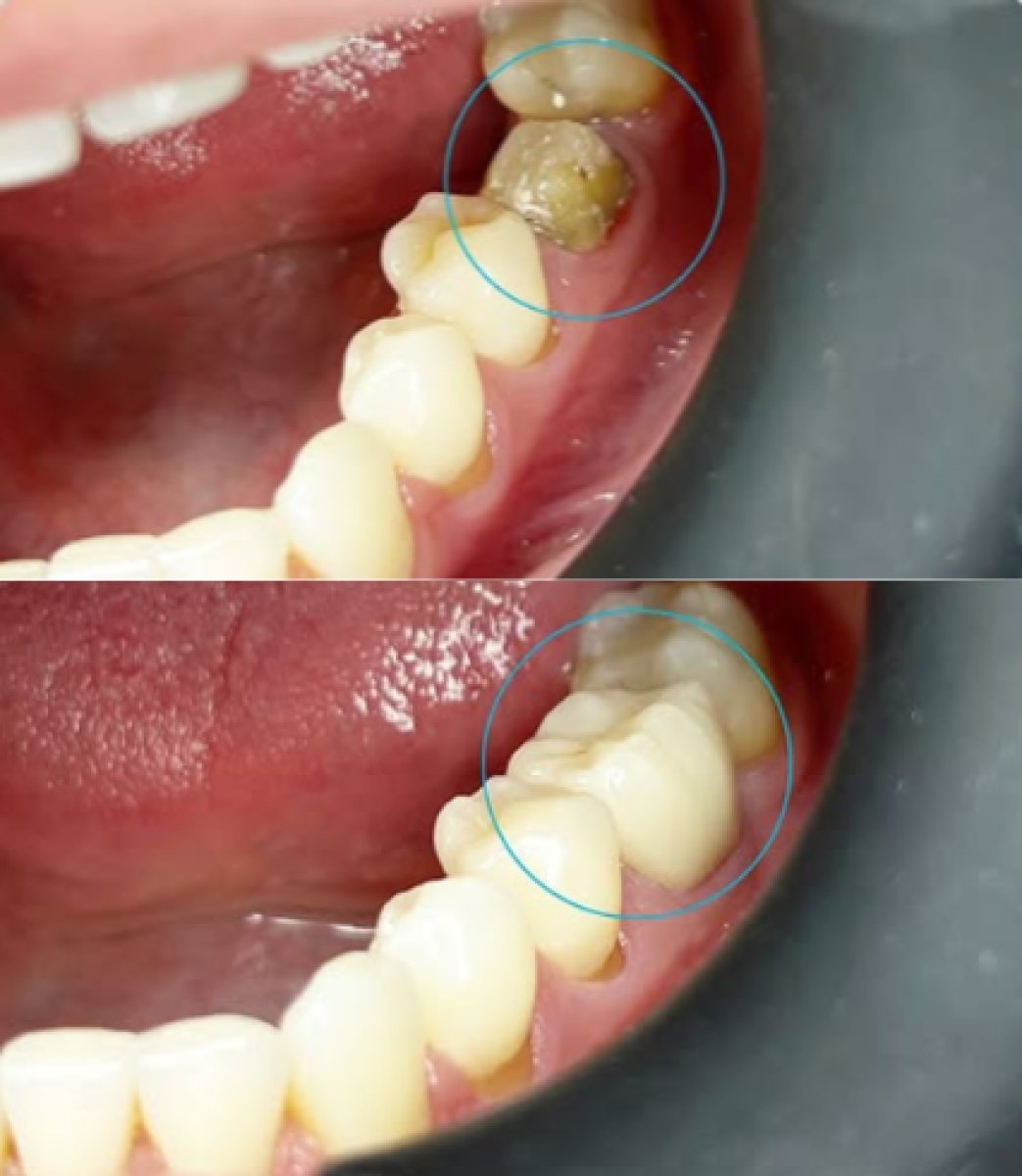 До и после установки зубной коронки в Dental Bliss, восстановленный моляр