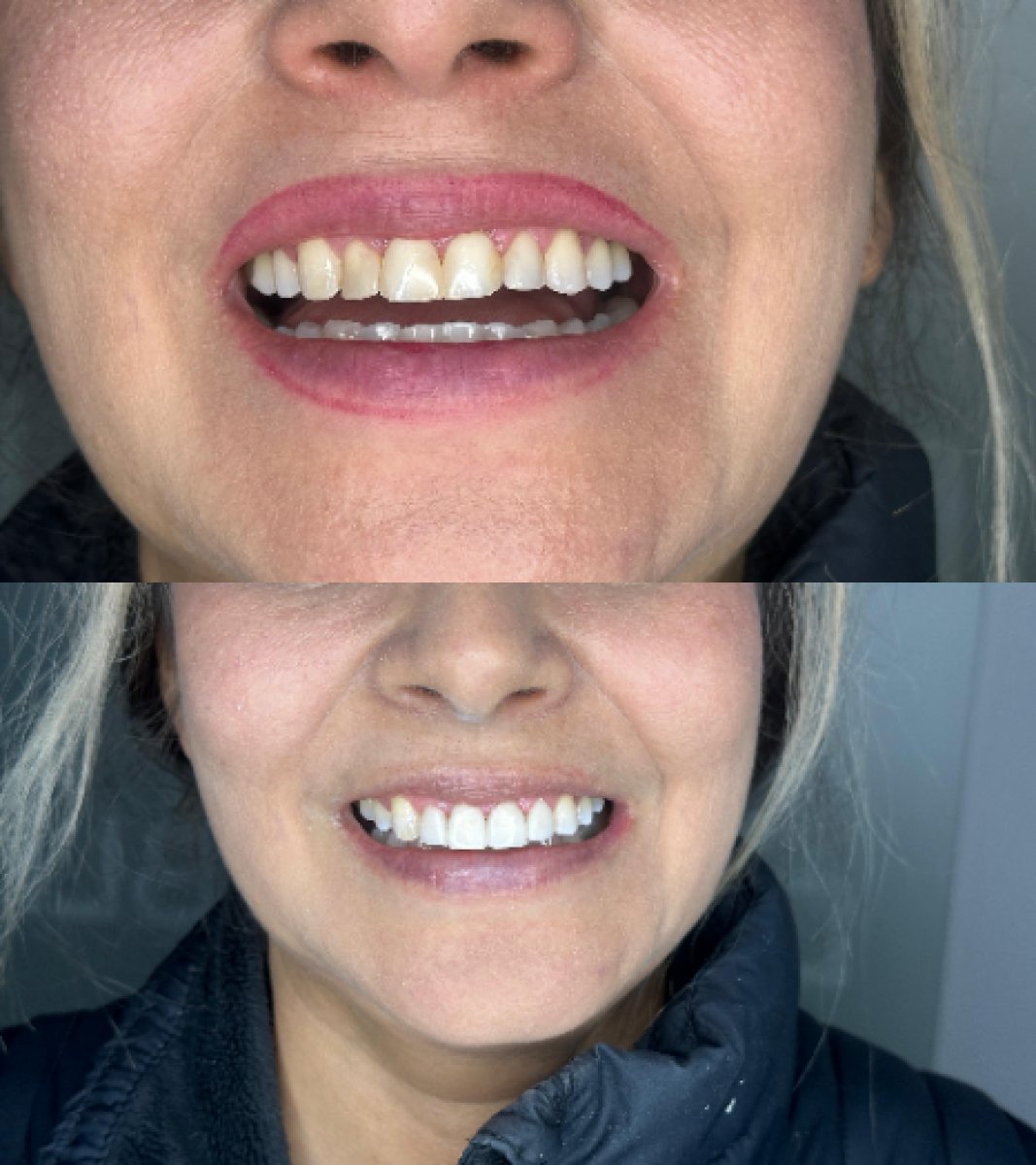 Resultados de antes y después del cambio de sonrisa en Dental Bliss: dientes alineados y blancos
