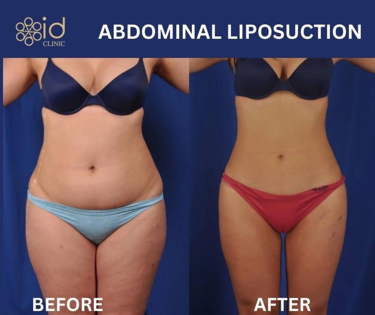 Resultados de liposucción abdominal antes y después en ID Clinic Bangkok, cintura más delgada