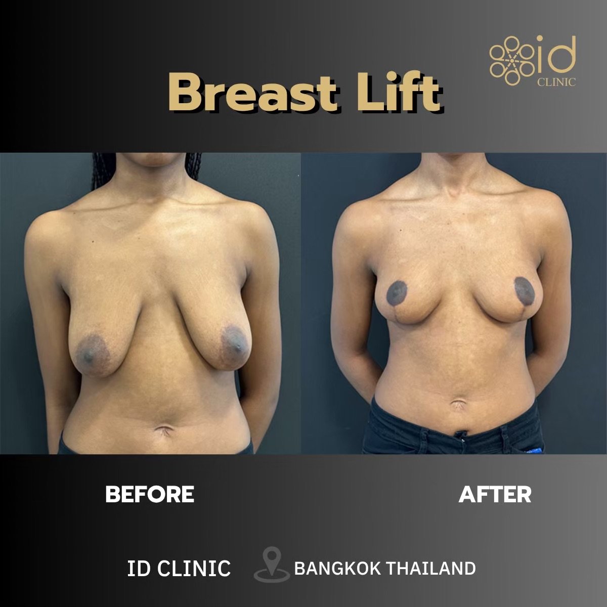 Resultados de lifting de senos antes y después en ID Clinic Bangkok, mejor contorno mamario