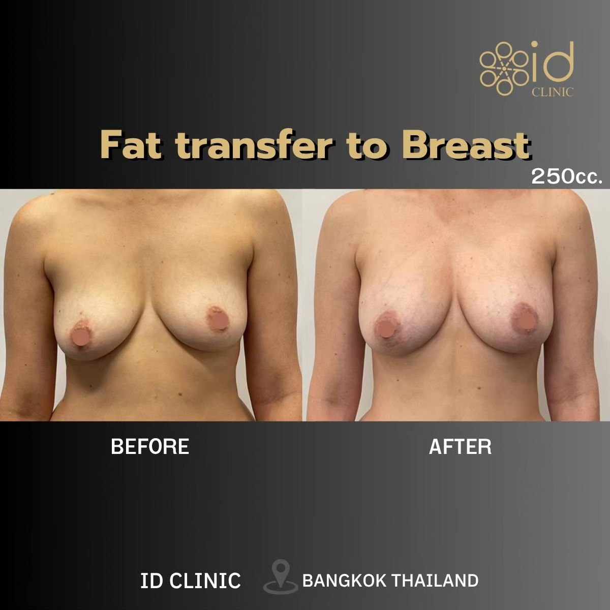 Resultados de transferencia de grasa a los senos en ID Clinic Bangkok, aumento natural