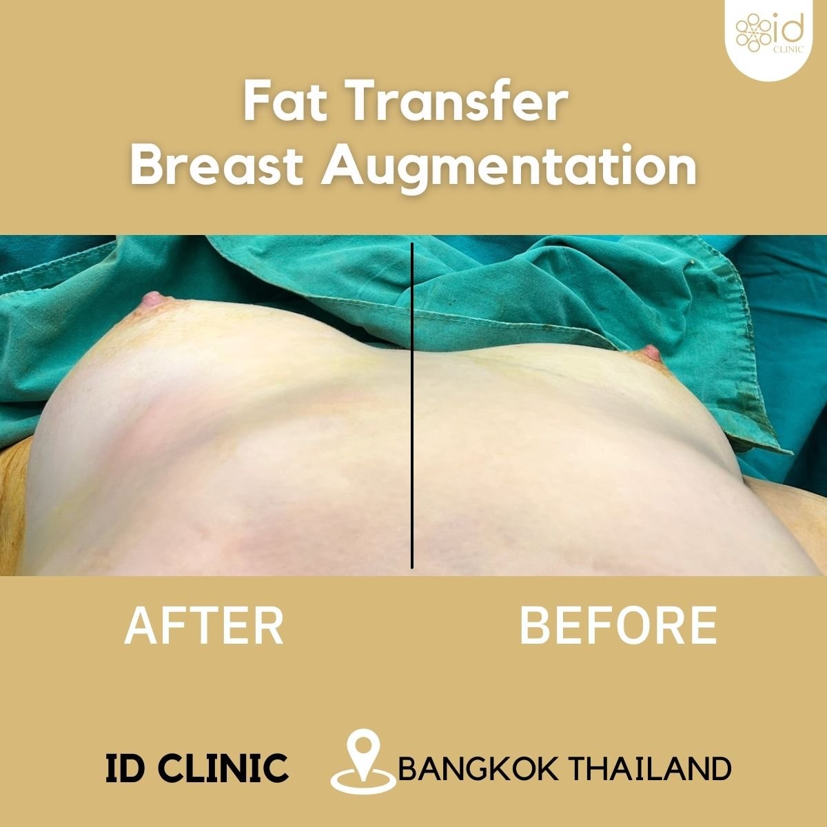 Resultados antes y después de aumento de senos con transferencia de grasa en ID Clinic Bangkok