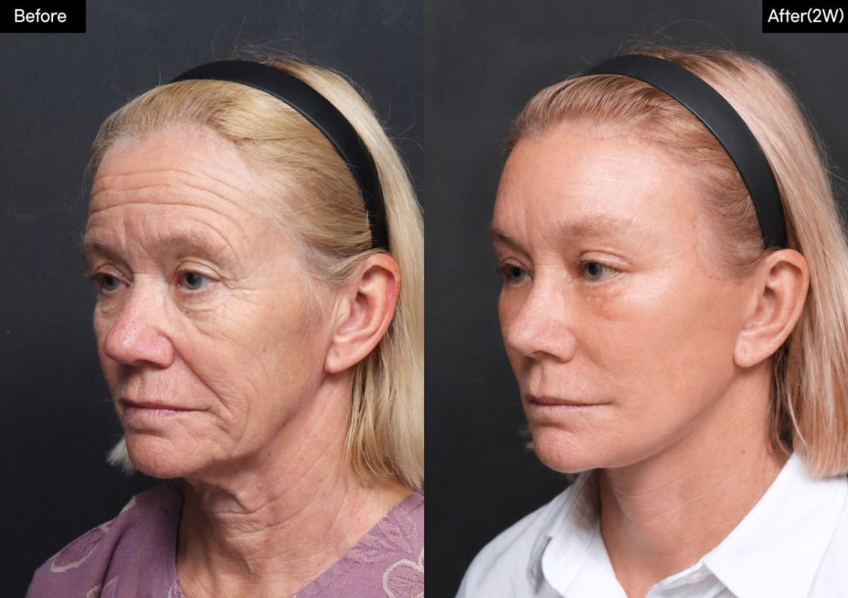نتائج قبل وبعد شد الوجه العميق في VG Plastic Surgery، تجديد شباب الوجه بوضوح
