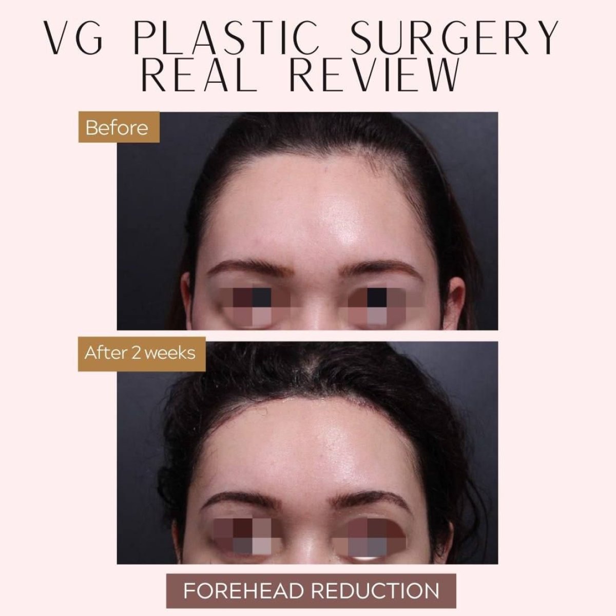 نتائج تصغير الجبهة قبل وبعد في VG Plastic Surgery، جبهة أصغر بشكل واضح