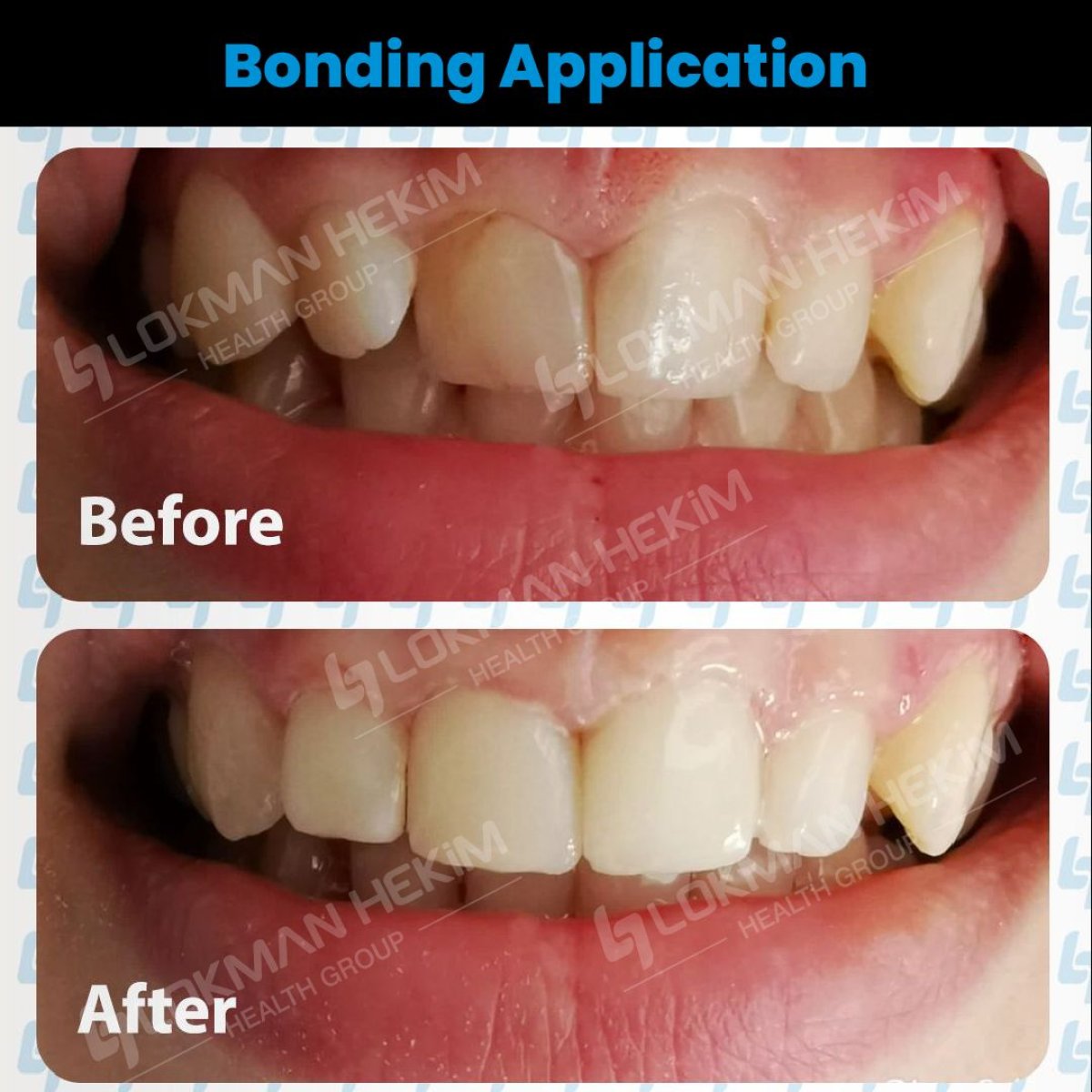 Resultados de antes y después de bonding dental en Lokman Hekim Istanbul Hospital, sonrisa mejorada