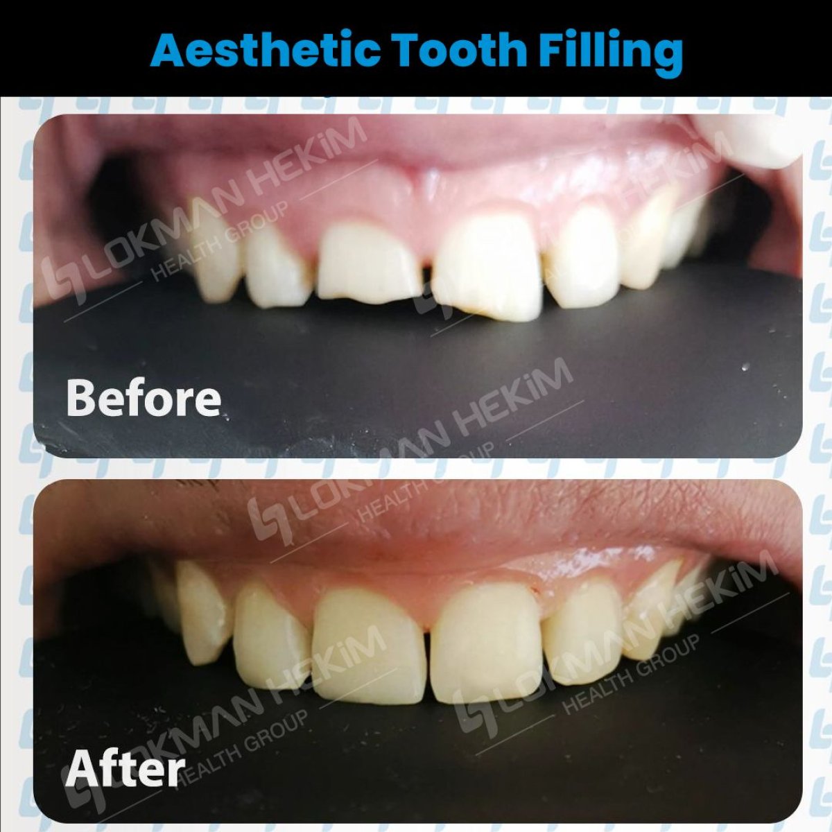 Resultados antes y después de relleno dental estético en Lokman Hekim Istanbul Hospital