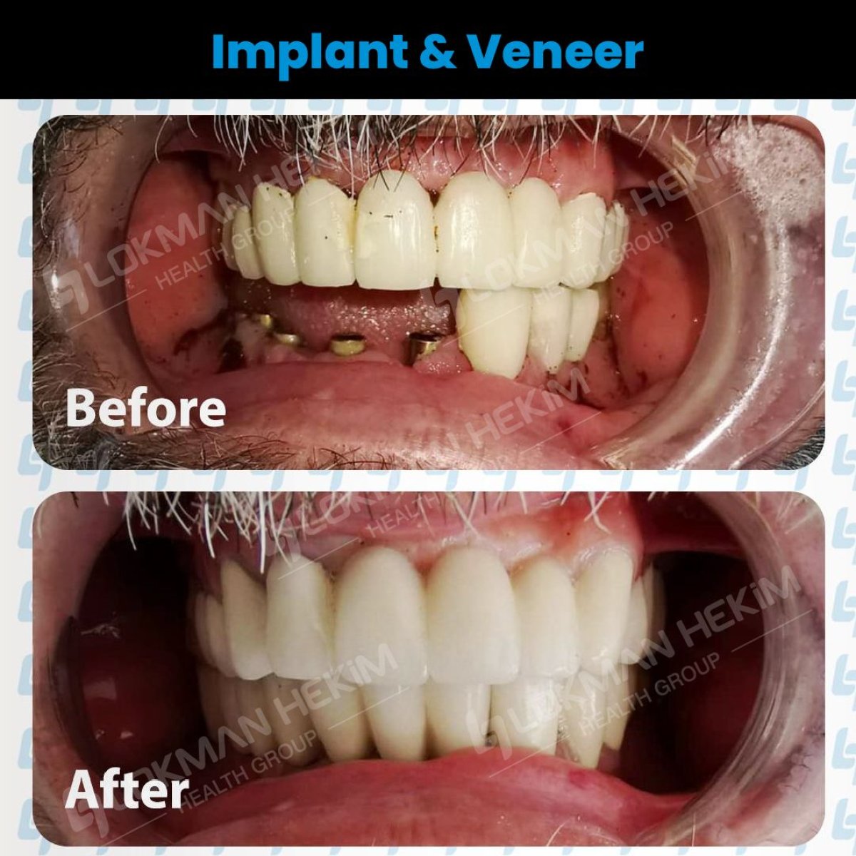 Antes y después de implantes dentales y carillas en Lokman Hekim Istanbul Hospital, resultado sonrisa