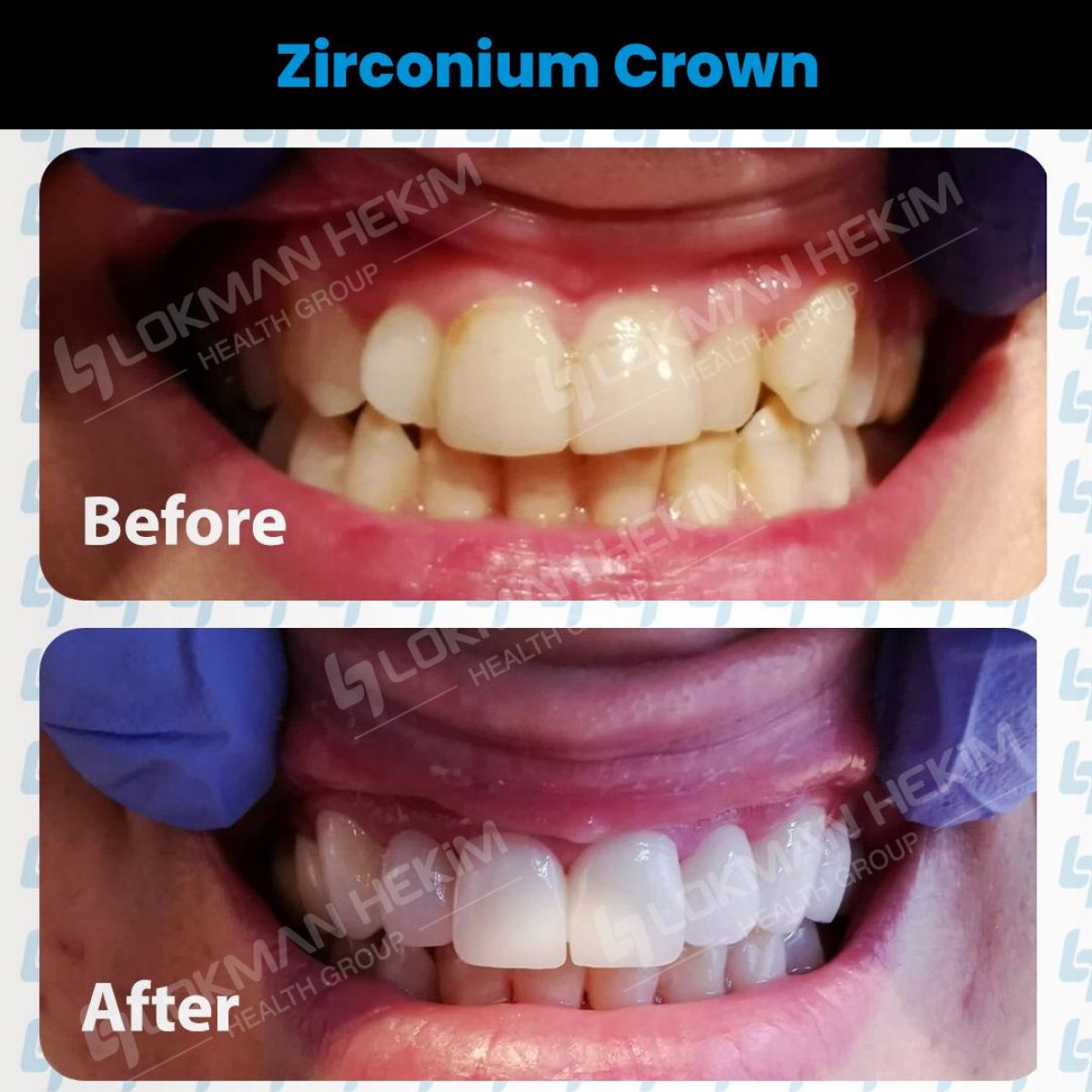 Resultados antes y después de coronas de zirconio en Lokman Hekim Istanbul Hospital, mejora de sonrisa