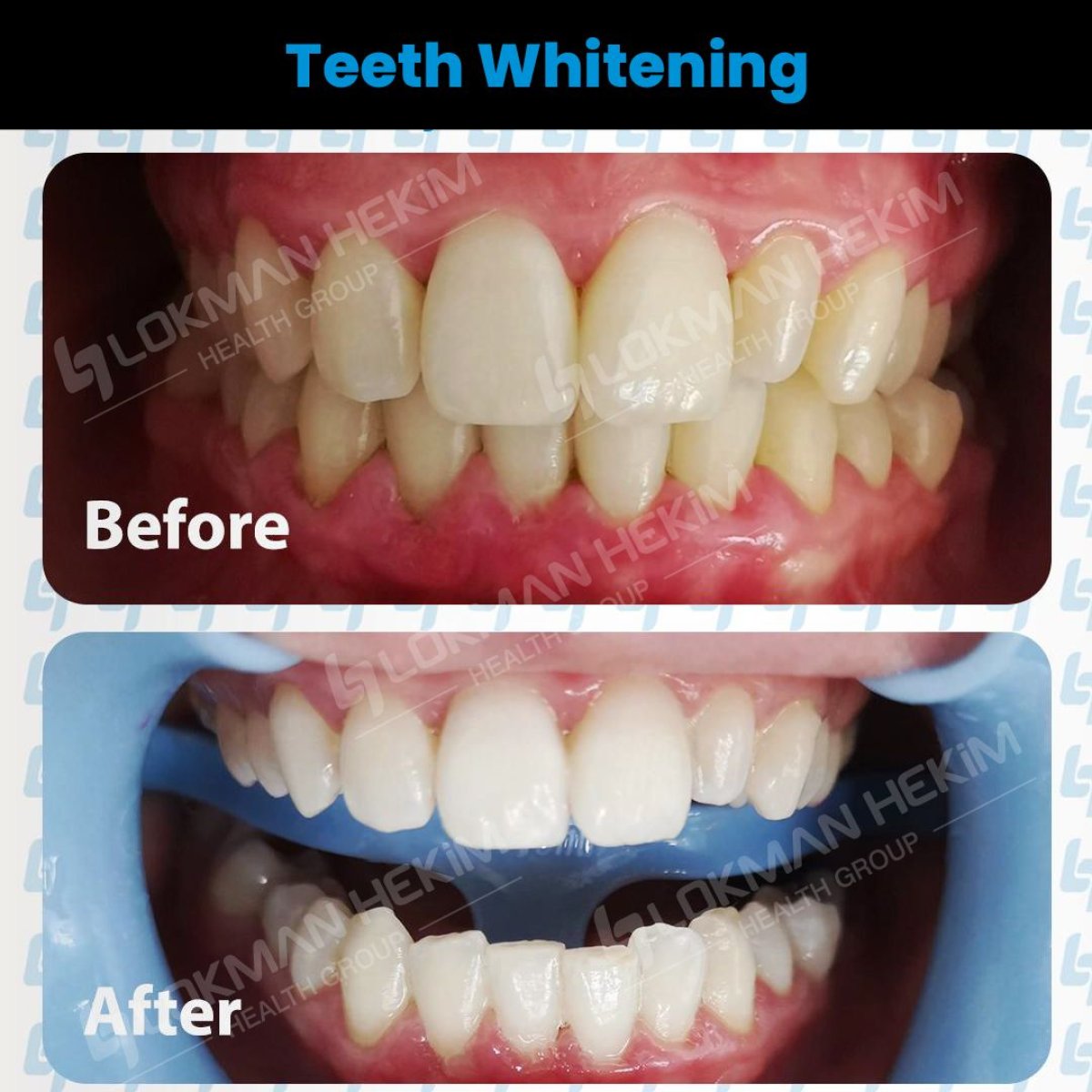 Resultados de blanqueamiento dental antes y después en Lokman Hekim Istanbul Hospital, sonrisa brillante