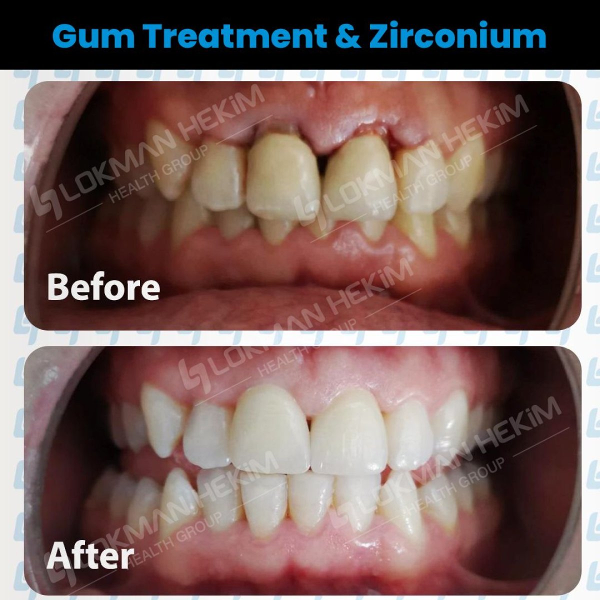 Resultados antes y después de tratamiento de encías y coronas de zirconio en Lokman Hekim Istanbul Hospital