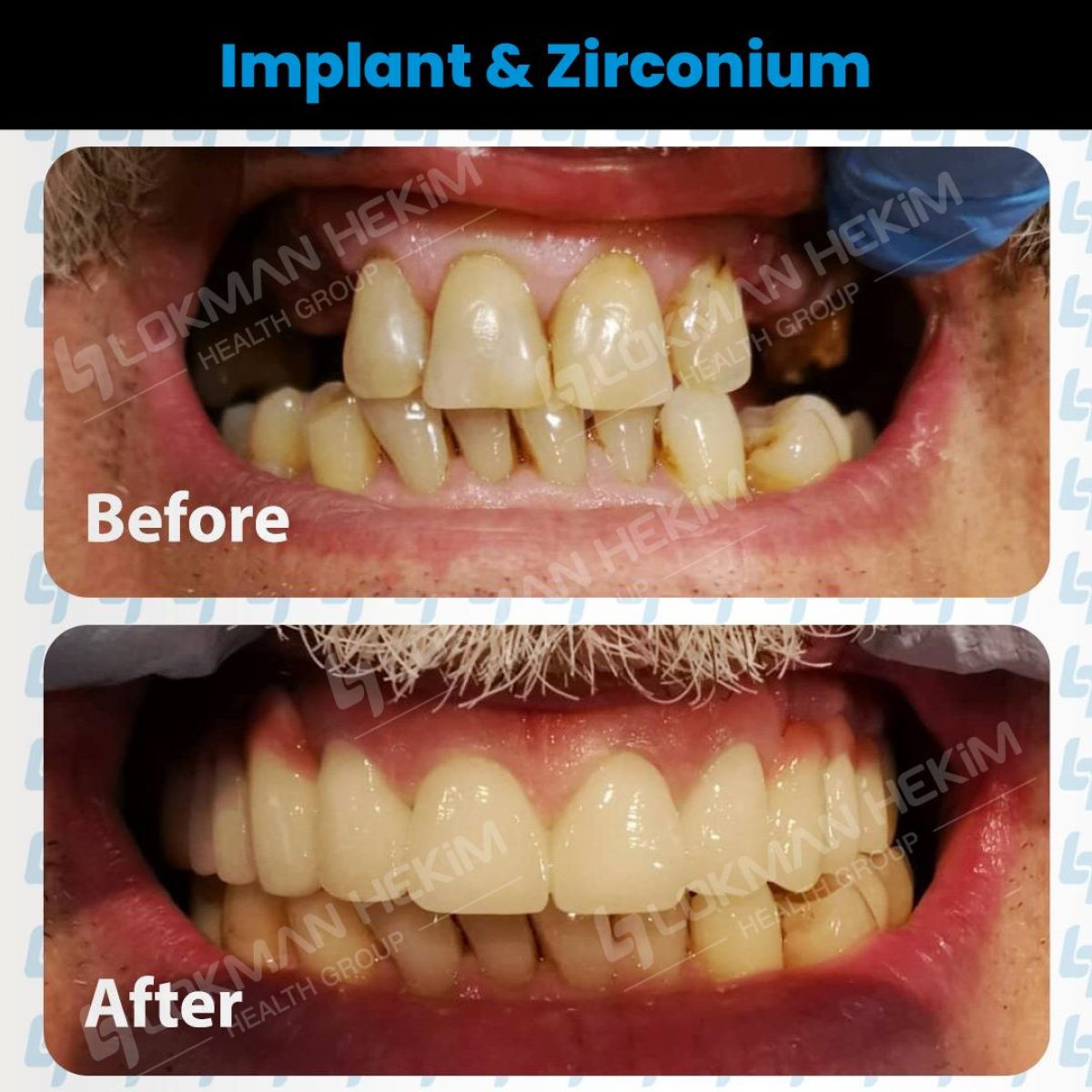 Resultados antes y después de implantes dentales y coronas de zirconio en Lokman Hekim Estambul