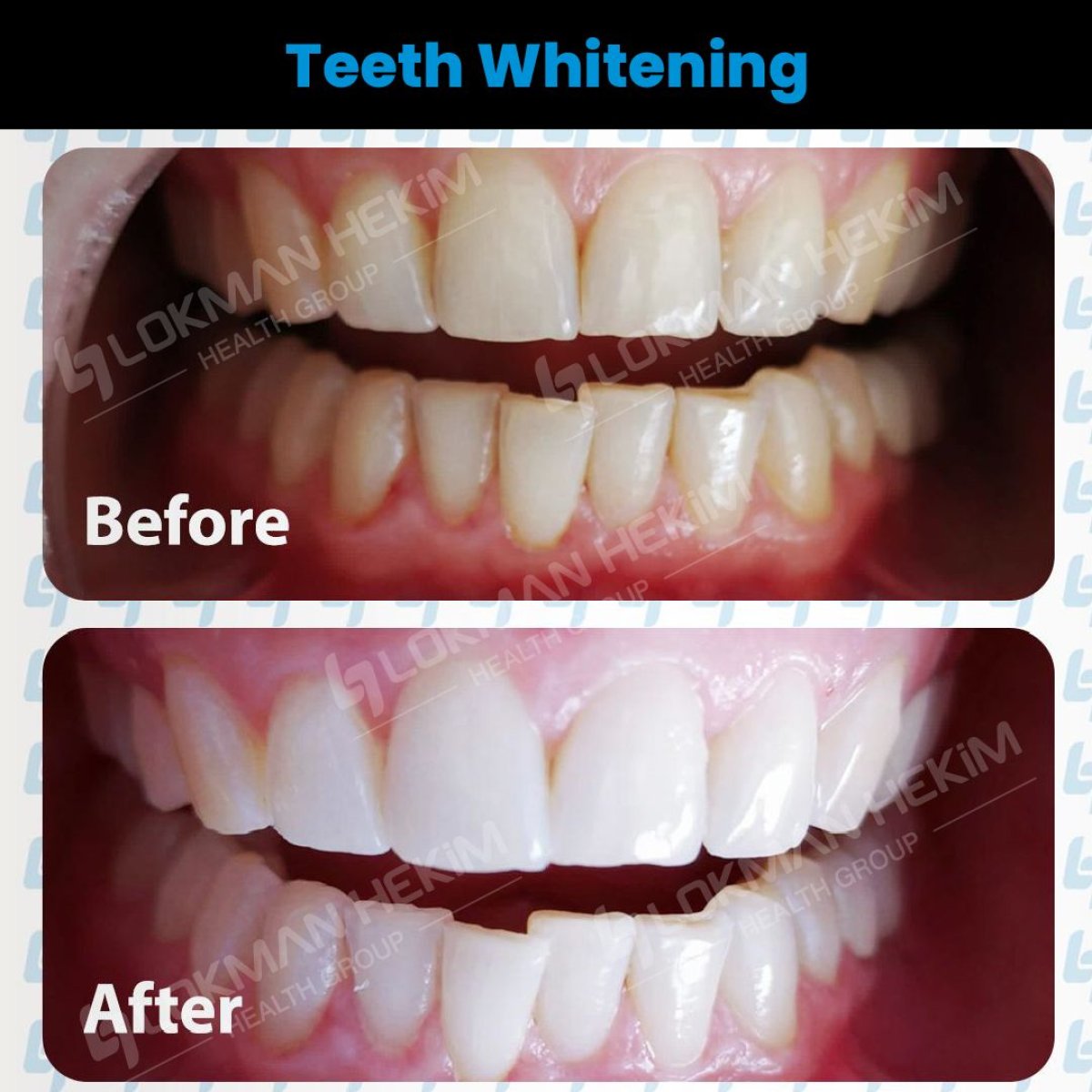 Resultados de blanqueamiento dental antes y después en Lokman Hekim Istanbul Hospital, sonrisa brillante