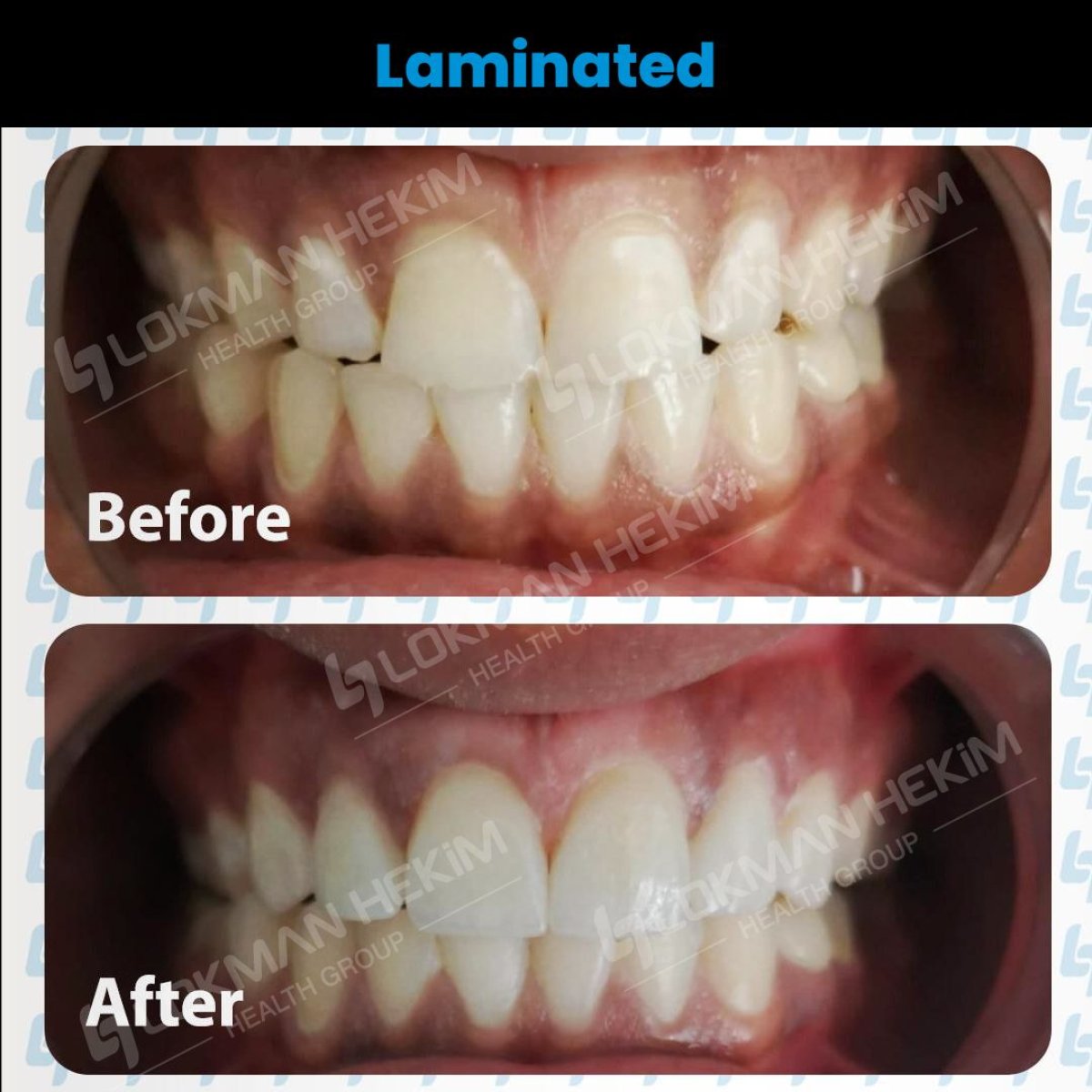 Resultados antes y después de carillas dentales en Lokman Hekim Istanbul Hospital, mejora de sonrisa