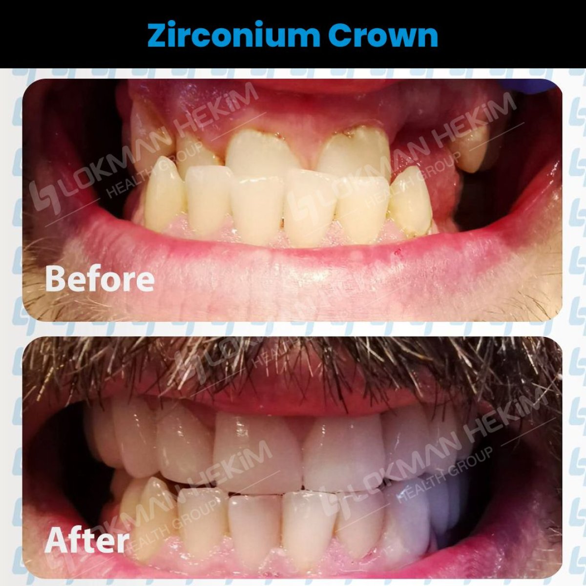 Resultados antes y después de coronas de zirconio en Lokman Hekim Istanbul Hospital, sonrisa mejorada