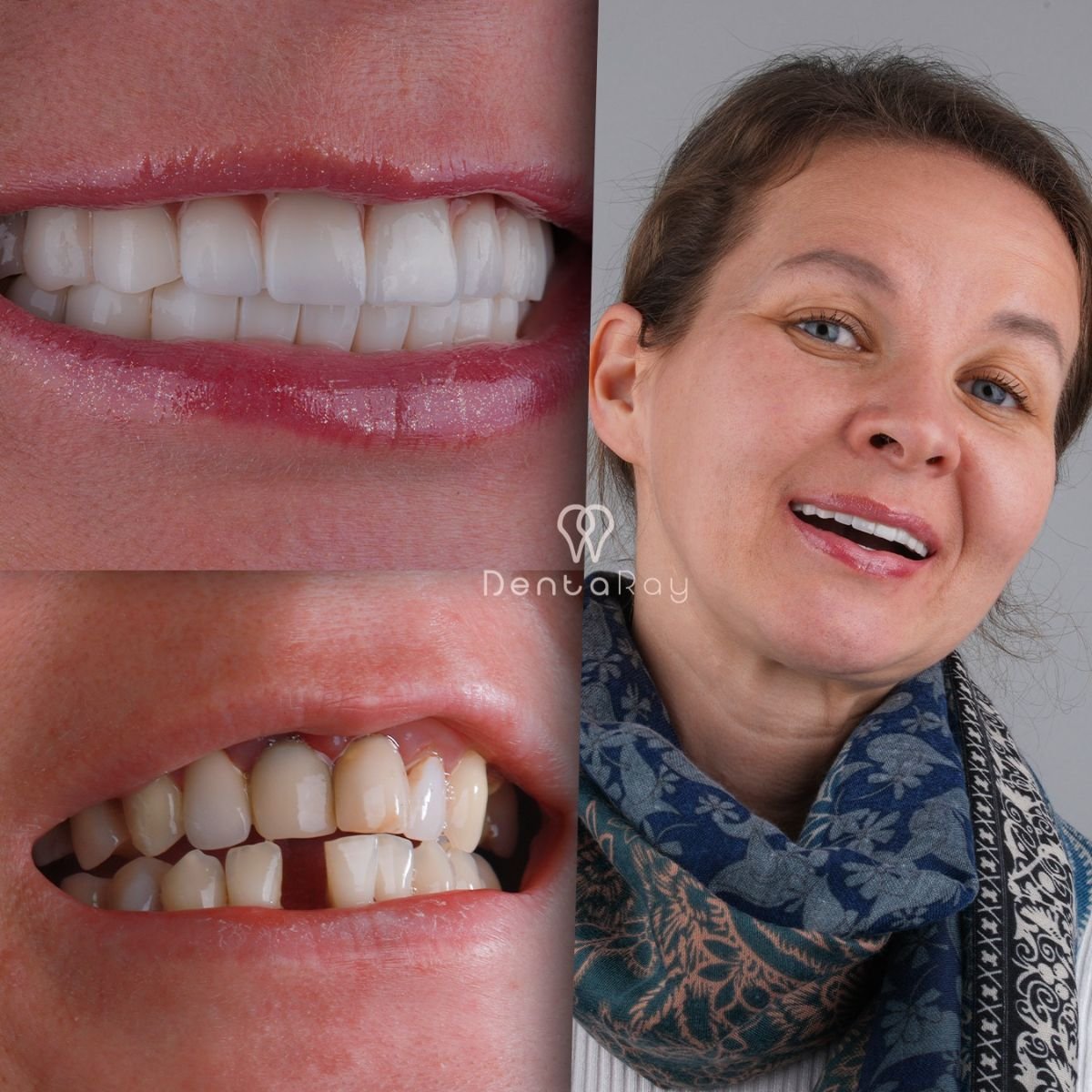 Antes y después de carillas dentales en Dentaray Clinic – sonrisa natural y renovada