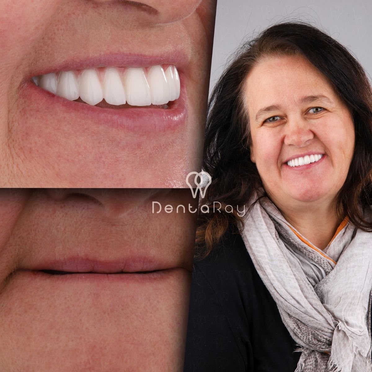 Resultado antes y después de implantes All-on-4 en Dentaray Clinic, restauración de sonrisa