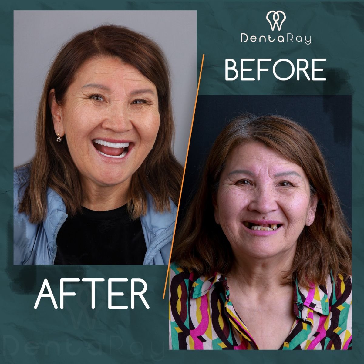 Resultados antes y después de implantes dentales All-on-4 en Dentaray Clinic, sonrisa completa